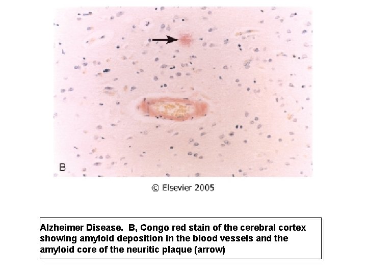 Alzheimer Disease. B, Congo red stain of the cerebral cortex showing amyloid deposition in