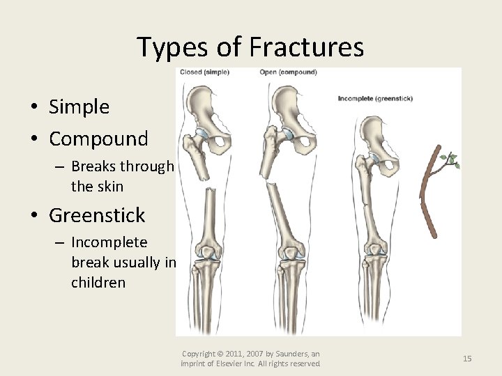 Types of Fractures • Simple • Compound – Breaks through the skin • Greenstick