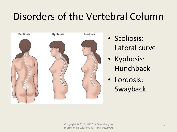 Disorders of the Vertebral Column • Scoliosis: Lateral curve • Kyphosis: Hunchback • Lordosis: