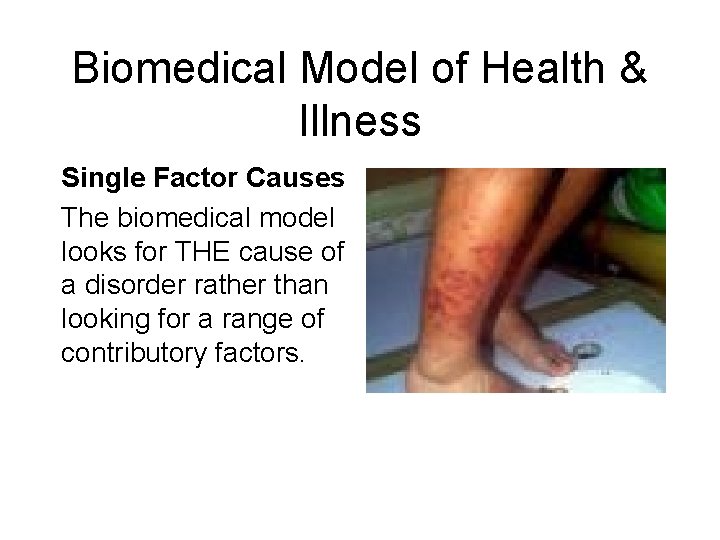 Biomedical Model of Health & Illness Single Factor Causes The biomedical model looks for