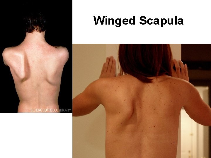 Winged Scapula 