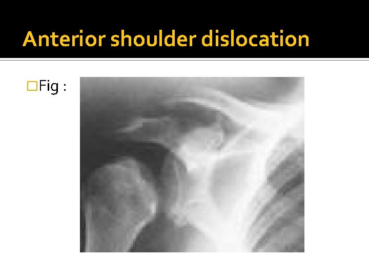 Anterior shoulder dislocation �Fig : 