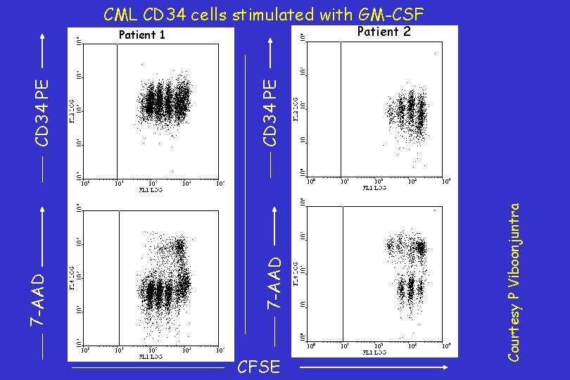 CML CD 34 cells stimulated with GM-CSF Patient 2 CFSE Courtesy P Viboonjuntra CD