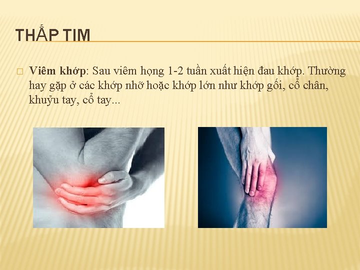 THẤP TIM � Viêm khớp: Sau viêm họng 1 -2 tuần xuất hiện đau