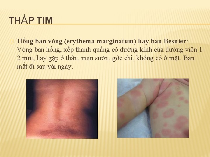 THẤP TIM � Hồng ban vòng (erythema marginatum) hay ban Besnier: Vòng ban hồng,