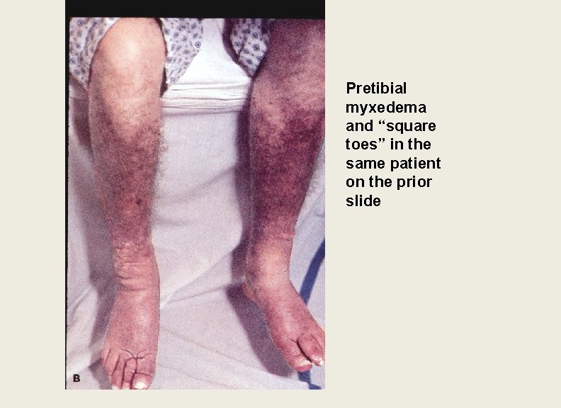 Pretibial myxedema and “square toes” in the same patient on the prior slide 