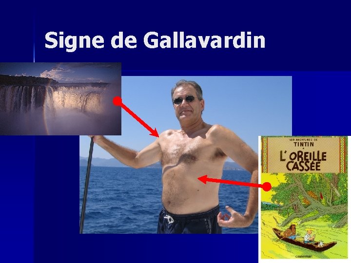 Signe de Gallavardin 