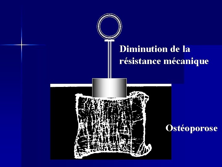 Diminution de la résistance mécanique Ostéoporose 