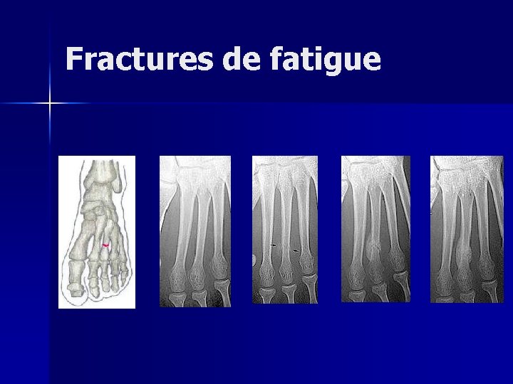 Fractures de fatigue 