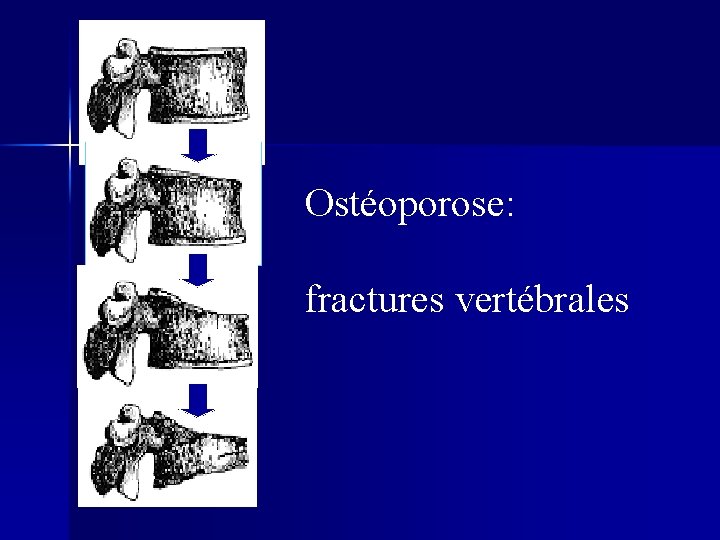 Ostéoporose: fractures vertébrales 