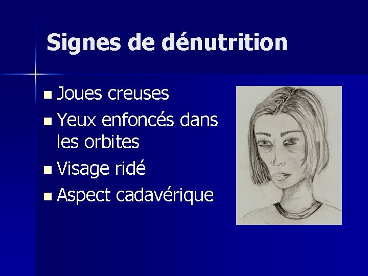 Signes de dénutrition n Joues creuses n Yeux enfoncés dans les orbites n Visage