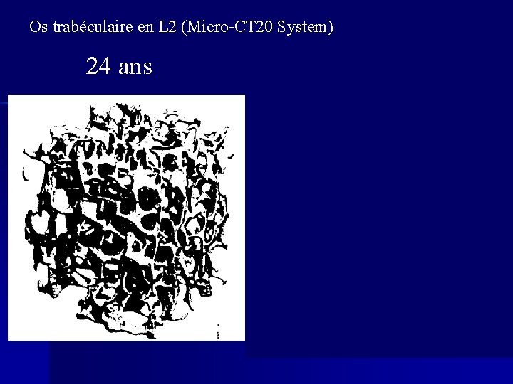 Os trabéculaire en L 2 (Micro-CT 20 System) 24 ans 85 years 