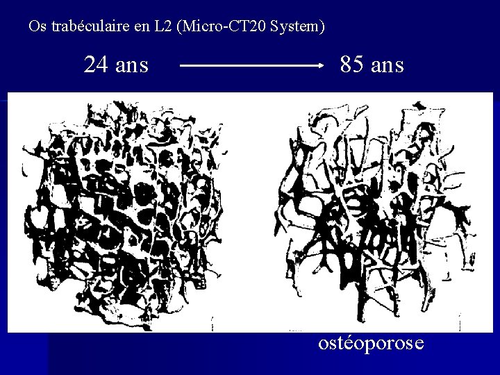 Os trabéculaire en L 2 (Micro-CT 20 System) 24 ans 85 ans ostéoporose 