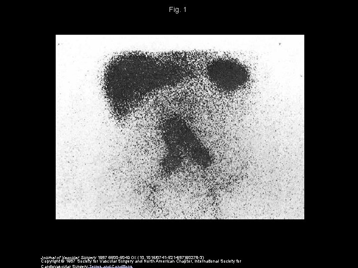 Fig. 1 Journal of Vascular Surgery 1987 6600 -604 DOI: (10. 1016/0741 -5214(87)90278 -3)