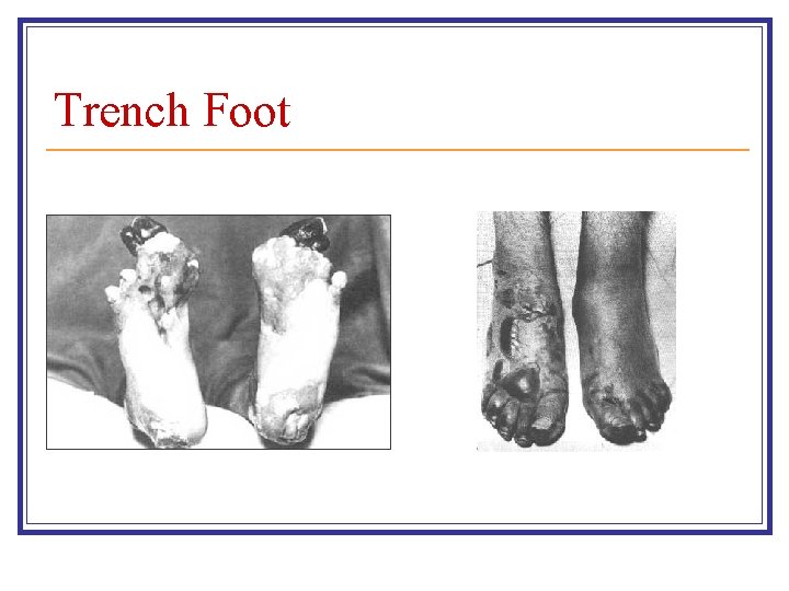 Trench Foot 