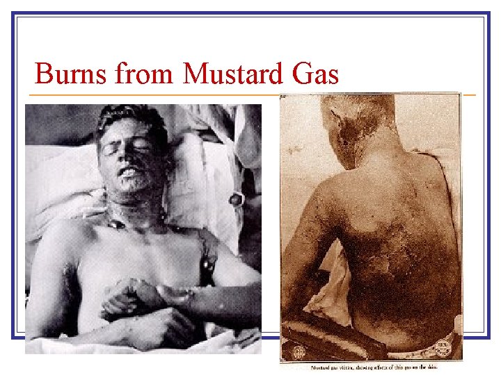 Burns from Mustard Gas 