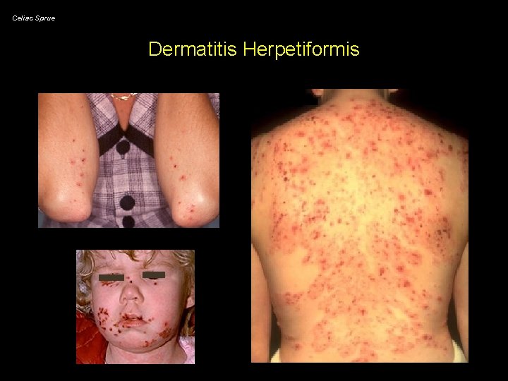 Celiac Sprue Dermatitis Herpetiformis 