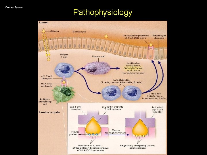 Celiac Sprue Pathophysiology 