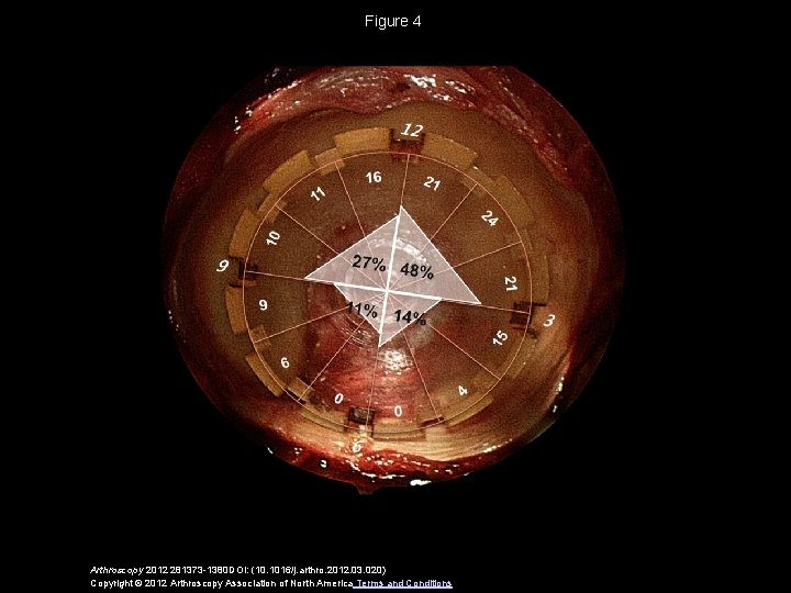 Figure 4 Arthroscopy 2012 281373 -1380 DOI: (10. 1016/j. arthro. 2012. 03. 020) Copyright