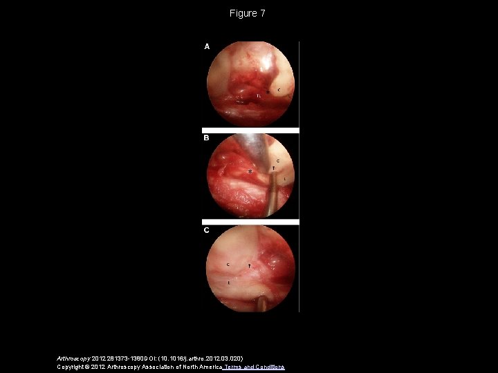 Figure 7 Arthroscopy 2012 281373 -1380 DOI: (10. 1016/j. arthro. 2012. 03. 020) Copyright