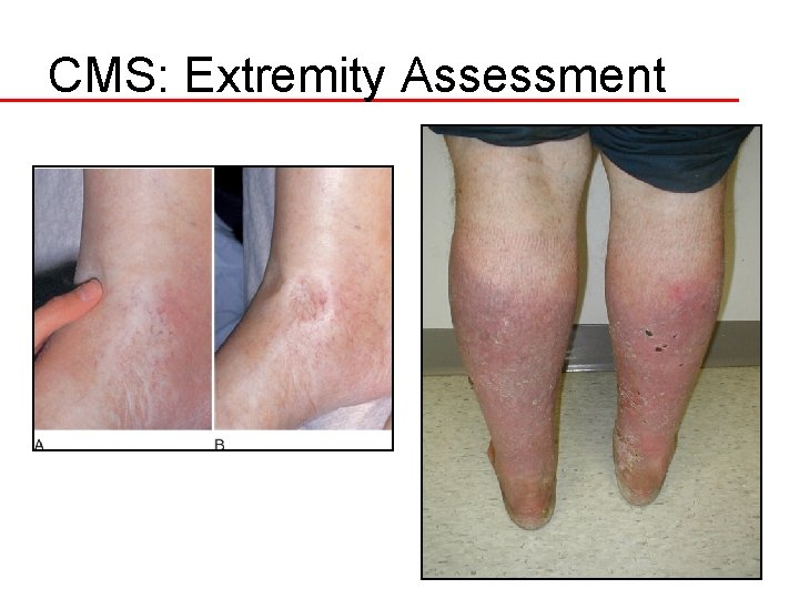 CMS: Extremity Assessment 