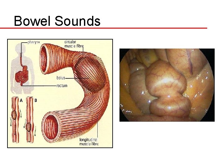 Bowel Sounds 