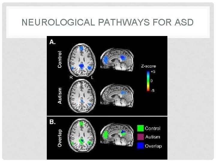 NEUROLOGICAL PATHWAYS FOR ASD 