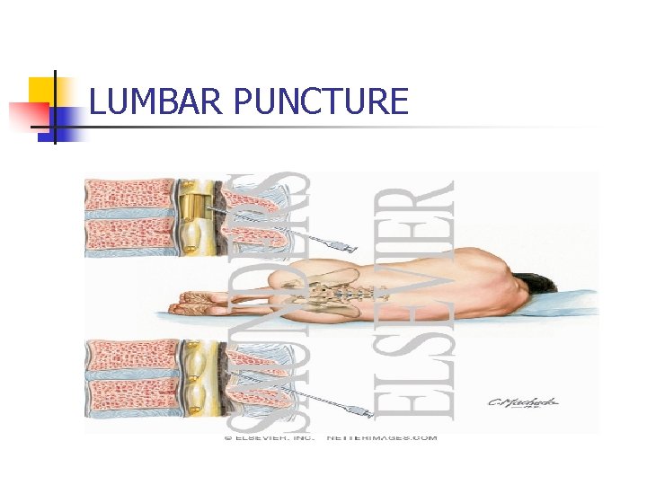 LUMBAR PUNCTURE 