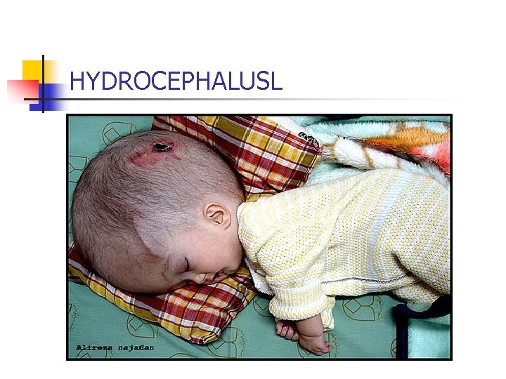 HYDROCEPHALUSL 