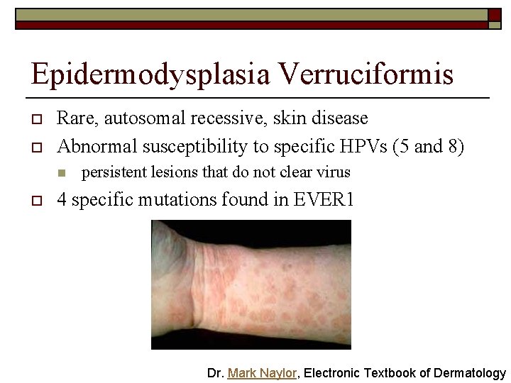 Epidermodysplasia Verruciformis o o Rare, autosomal recessive, skin disease Abnormal susceptibility to specific HPVs