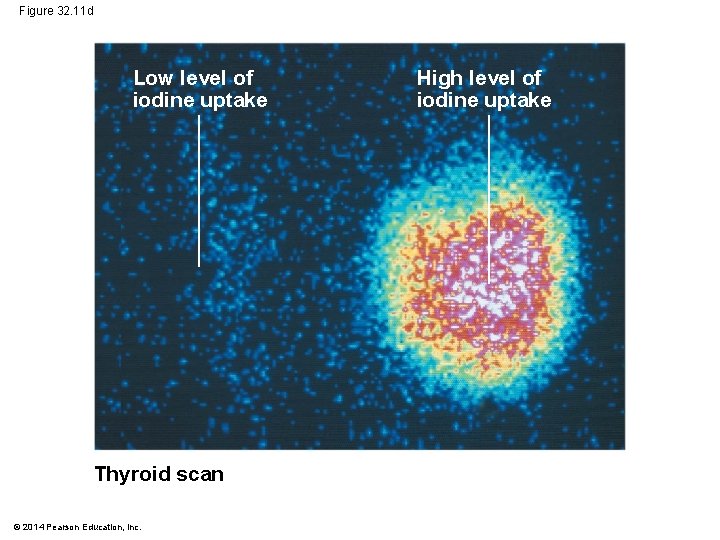 Figure 32. 11 d Low level of iodine uptake Thyroid scan © 2014 Pearson