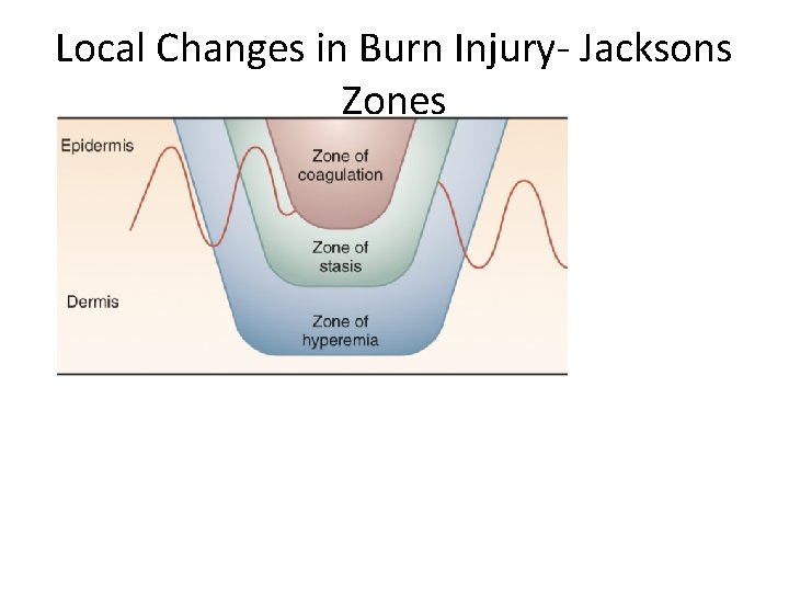 Local Changes in Burn Injury- Jacksons Zones 