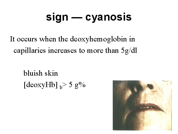 sign — cyanosis It occurs when the deoxyhemoglobin in capillaries increases to more than