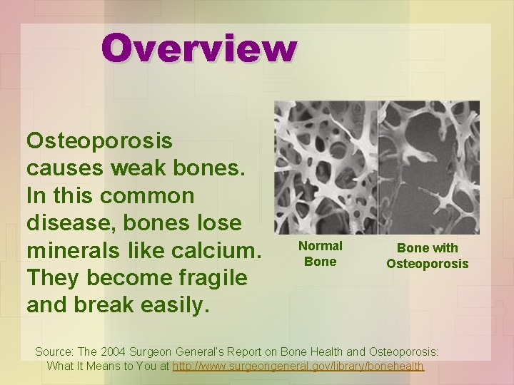 Overview Osteoporosis causes weak bones. In this common disease, bones lose minerals like calcium.