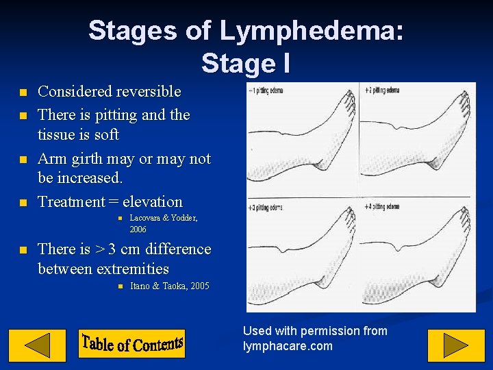 Stages of Lymphedema: Stage I n n Considered reversible There is pitting and the