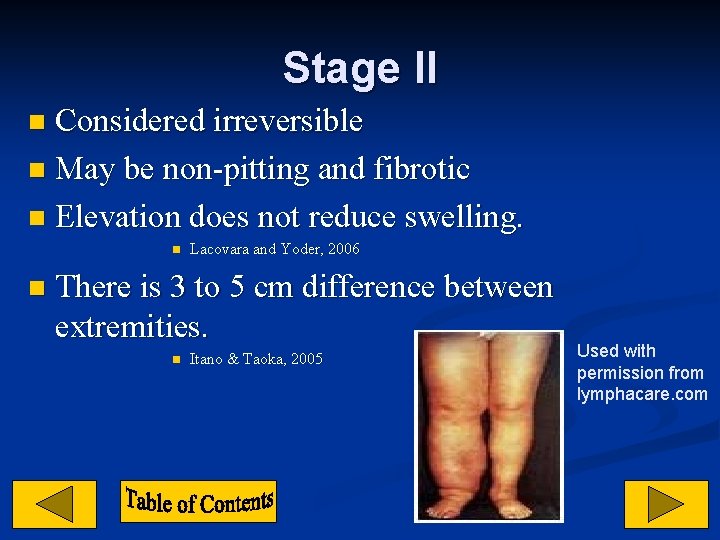 Stage II Considered irreversible n May be non-pitting and fibrotic n Elevation does not