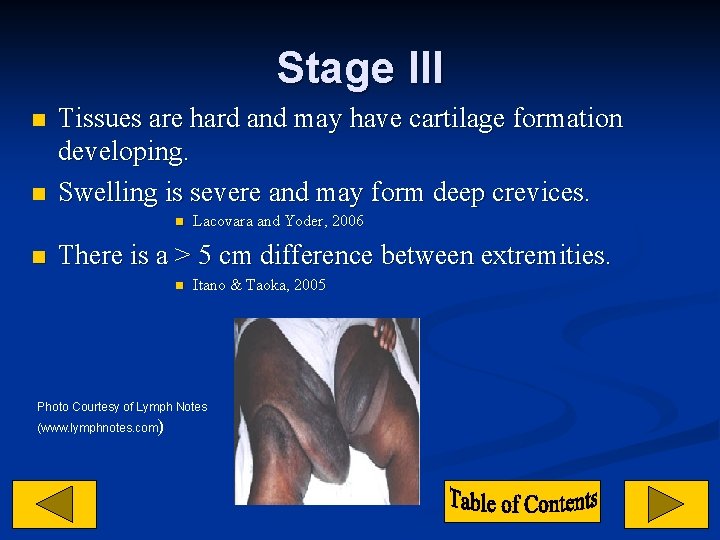 Stage III n n Tissues are hard and may have cartilage formation developing. Swelling