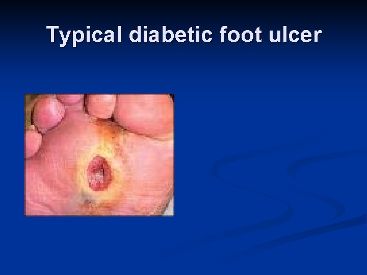 Typical diabetic foot ulcer 