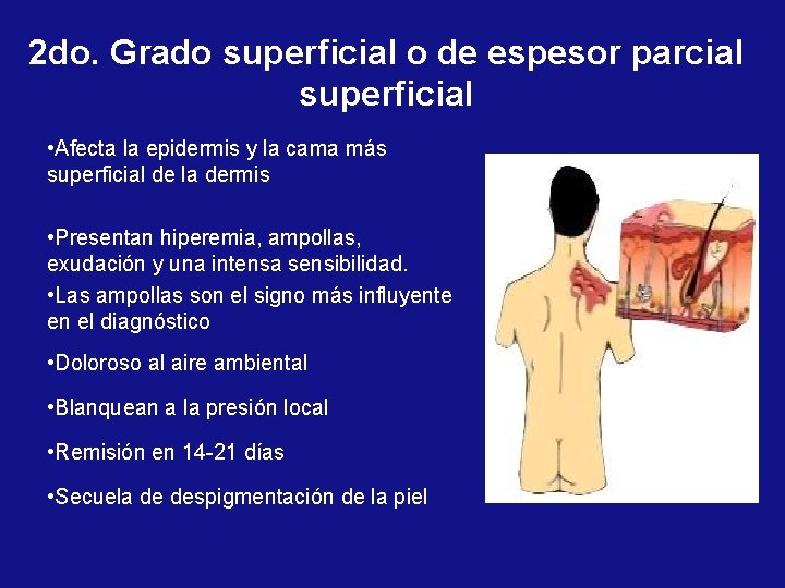 2 do. Grado superficial o de espesor parcial superficial • Afecta la epidermis y