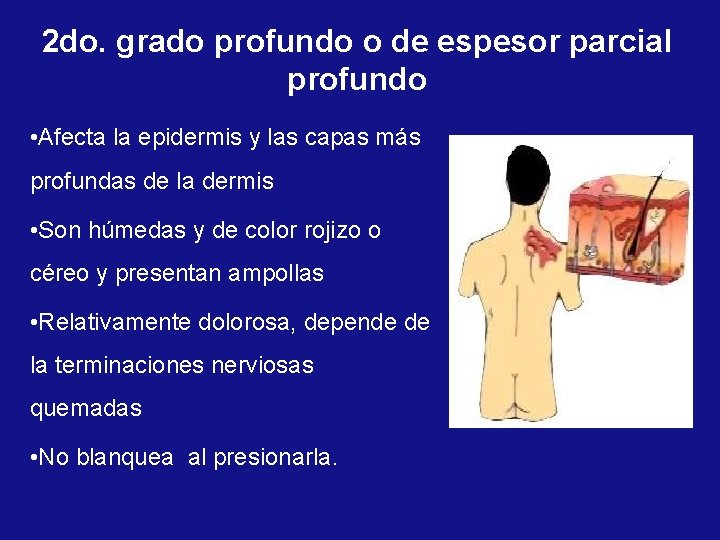 2 do. grado profundo o de espesor parcial profundo • Afecta la epidermis y