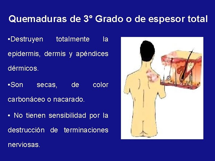 Quemaduras de 3° Grado o de espesor total • Destruyen totalmente la epidermis, dermis