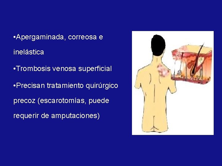  • Apergaminada, correosa e inelástica • Trombosis venosa superficial • Precisan tratamiento quirúrgico