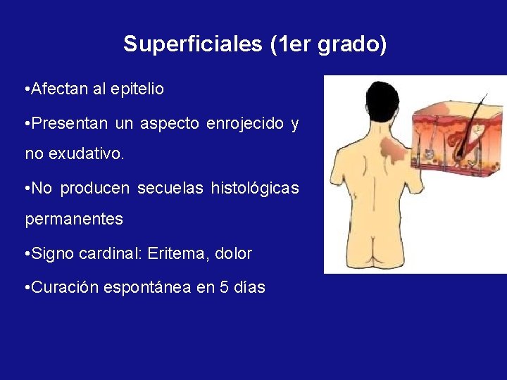 Superficiales (1 er grado) • Afectan al epitelio • Presentan un aspecto enrojecido y
