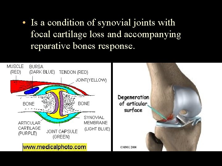  • Is a condition of synovial joints with focal cartilage loss and accompanying