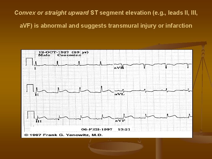 Convex or straight upward ST segment elevation (e. g. , leads II, III, a.