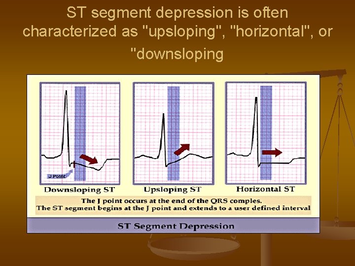 ST segment depression is often characterized as "upsloping", "horizontal", or "downsloping 