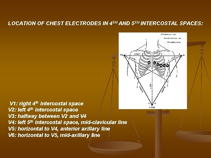 LOCATION OF CHEST ELECTRODES IN 4 TH AND 5 TH INTERCOSTAL SPACES: V 1:
