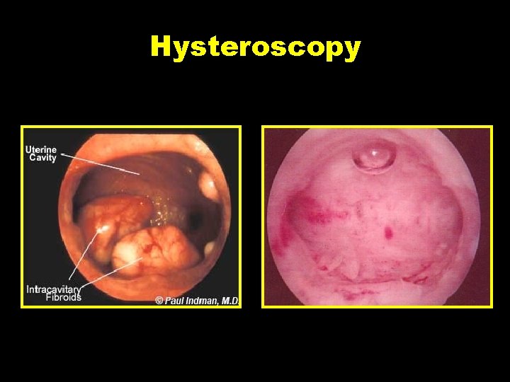 Hysteroscopy 