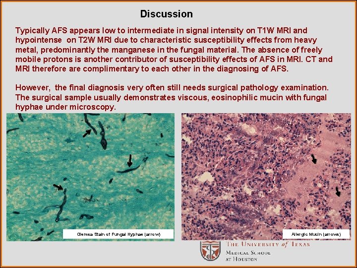 Discussion Typically AFS appears low to intermediate in signal intensity on T 1 W