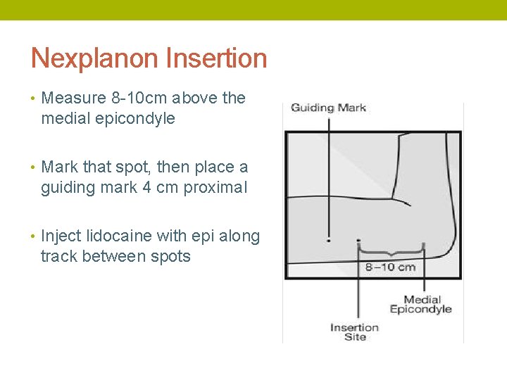 Nexplanon Insertion • Measure 8 -10 cm above the medial epicondyle • Mark that
